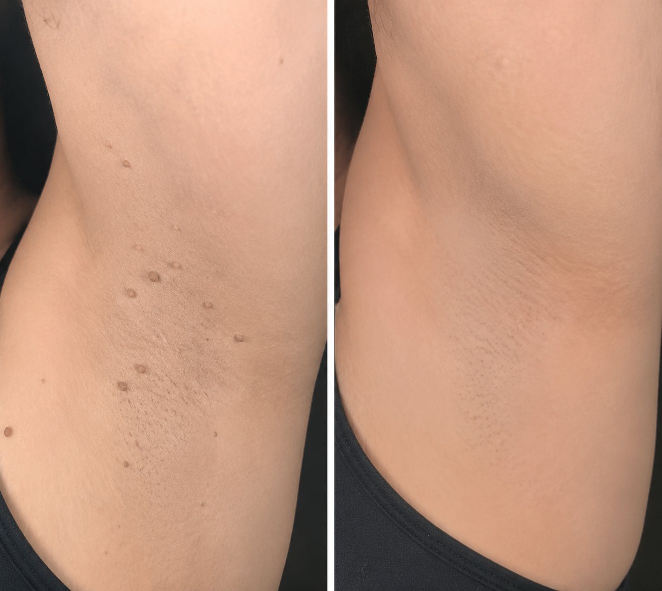 ✨ShapeOil®2-in-1 Microneedle & Hydrocolloid Patch🍀| Removes Raised Moles, Acne, Flat Warts & Skin Tags | Helps Improve Wrinkles, Scars & Blemishes | Invisible Patches for Face & Body